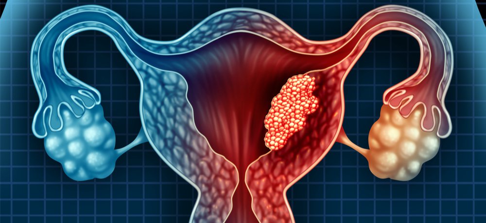 Test could help rule out endometrial cancer in three hours - Med-Tech